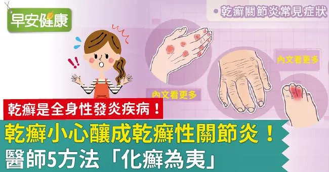 乾癬小心釀成乾癬性關節炎！醫師5方法「化癬為夷」