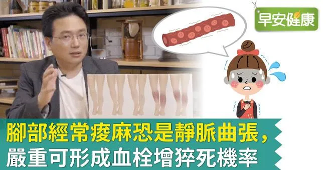 腳部經常痠麻恐是靜脈曲張，嚴重可形成血栓增猝死機率