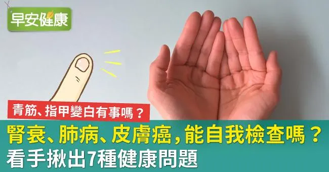 腎衰、肺病、皮膚癌，能自我檢查嗎？看手揪出7種健康問題
