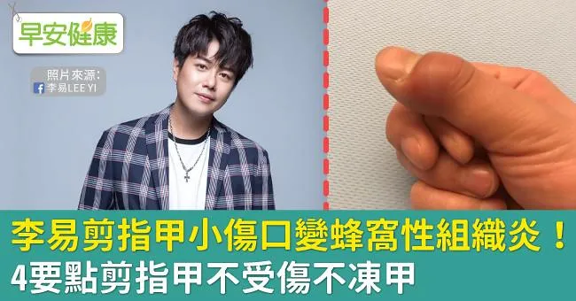 李易剪指甲小傷口變蜂窩性組織炎！4要點剪指甲不受傷不凍甲