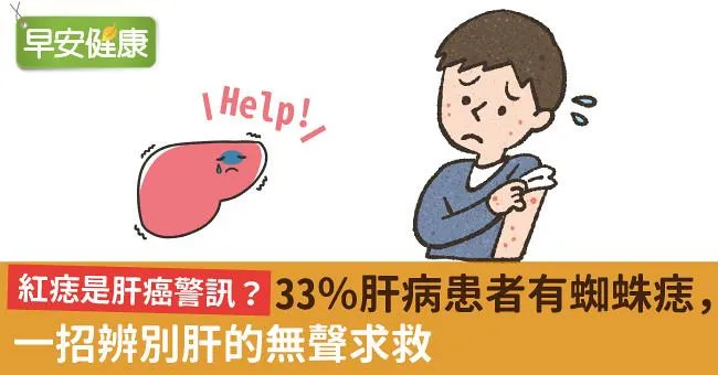 紅痣是肝癌警訊？33％肝病患者有蜘蛛痣，一招辨別肝的無聲求救