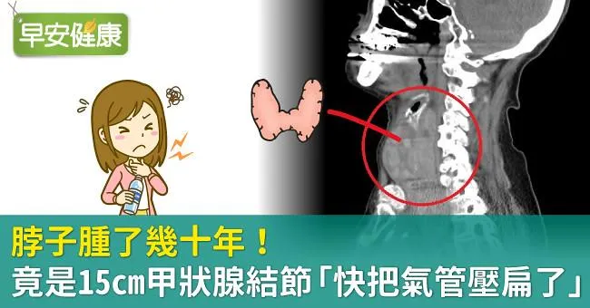 脖子腫了幾十年！竟是15cm甲狀腺結節「快把氣管壓扁了」