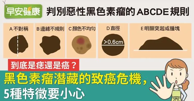 到底是痣還是癌？黑色素瘤潛藏的致癌危機，5種特徵要小心
