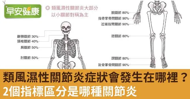 類風濕性關節炎症狀會發生在哪裡？2個指標區分是哪種關節炎