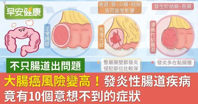 大腸癌風險變高！發炎性腸道疾病竟有10個意想不到的症狀