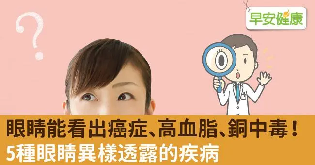 眼睛能看出癌症、高血脂、銅中毒！5種眼睛異樣透露的疾病