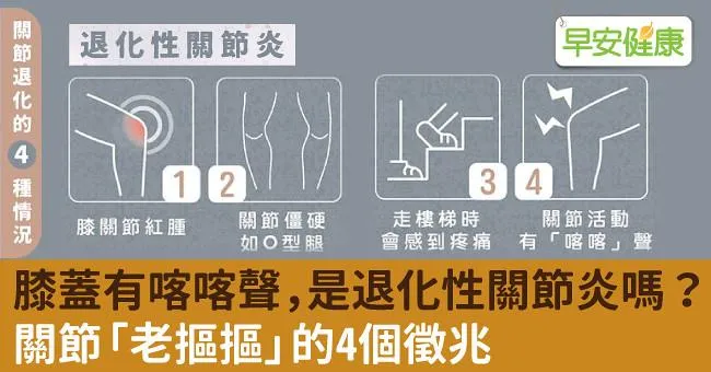 膝蓋有喀喀聲，是退化性關節炎嗎？關節「老摳摳」的4個徵兆