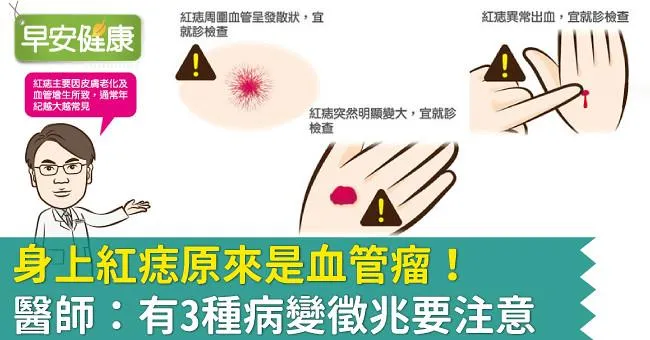 身上紅痣原來是血管瘤！醫師：有3種病變徵兆要注意