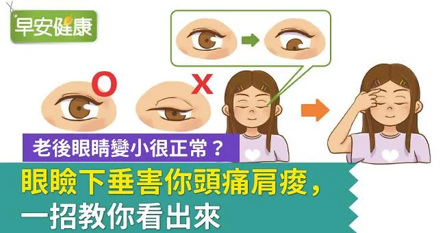 老後眼睛變小很正常？眼瞼下垂害你頭痛肩痠，一招教你看出來