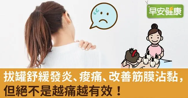 拔罐舒緩發炎、痠痛、改善筋膜沾黏，但絕不是越痛越有效！
