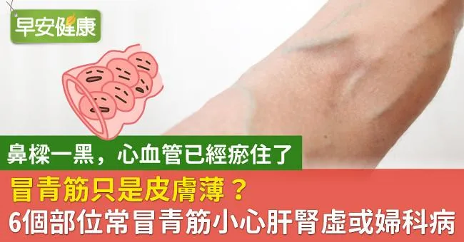 冒青筋只是皮膚薄？6個部位常冒青筋小心肝腎虛或婦科病
