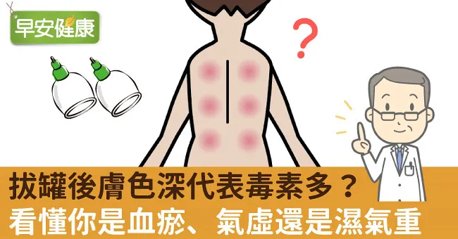 拔罐後膚色深代表毒素多？看懂你是血瘀、氣虛還是濕氣重