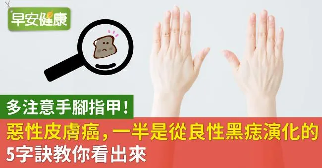 最惡性的皮膚癌，一半是從良性黑痣演化的！5字訣教你看出來