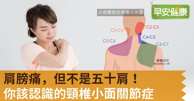 肩膀痛，但不是五十肩！你該認識的頸椎小面關節症