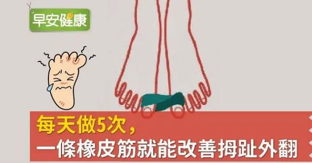 每天做5次，一條橡皮筋就能改善拇趾外翻
