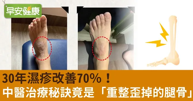 30年濕疹改善70％！中醫治療秘訣竟是「重整歪掉的腿骨」