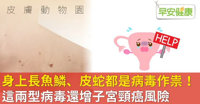 身上長魚鱗、皮蛇都是病毒作祟！這兩型病毒還增子宮頸癌風險