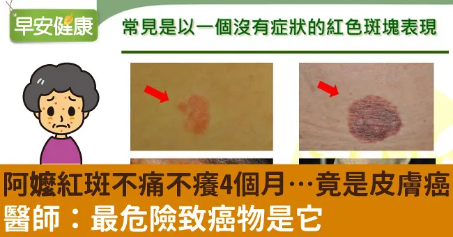 阿嬤紅斑不痛不癢4個月…竟是皮膚癌！醫師：最危險致癌物是它