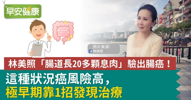 林美照「腸道長20多顆息肉」驗出腸癌！這種狀況癌風險高，極早期靠1招發現治療