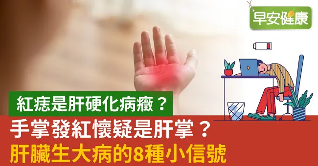 紅痣是肝硬化病癥？手掌發紅懷疑是肝掌？肝臟生大病的8種小信號