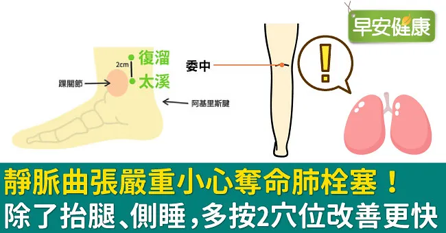 靜脈曲張嚴重小心奪命肺栓塞！除了抬腿、側睡，多按2穴位改善更快