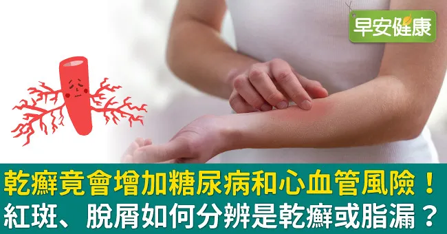 乾癬竟會增加糖尿病和心血管風險！紅斑、脫屑如何分辨是乾癬或脂漏？