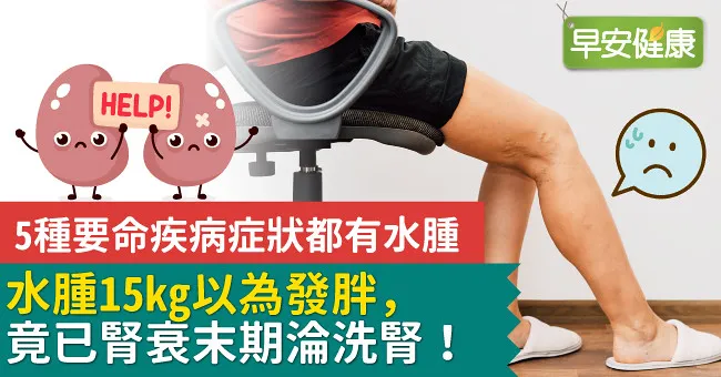 水腫15kg以為發胖，竟已腎衰末期淪洗腎！5種要命疾病症狀都有水腫