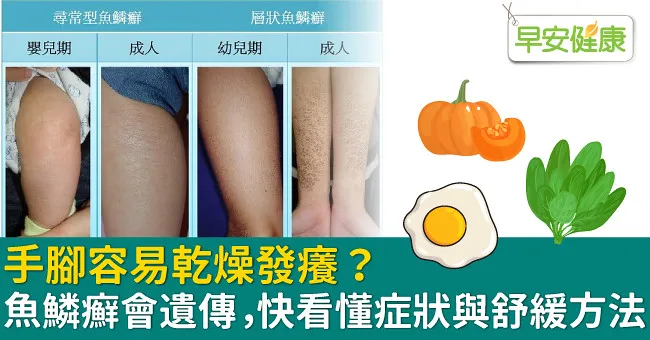 手腳容易乾燥發癢？魚鱗癬會遺傳，快看懂症狀與舒緩方法