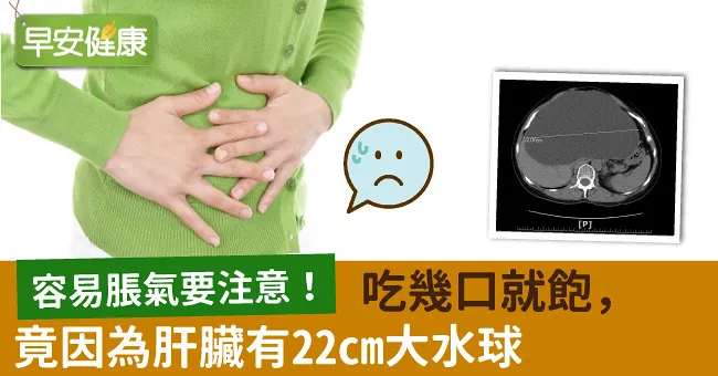 容易脹氣要注意！吃幾口就飽，竟因為肝臟有22cm大水球