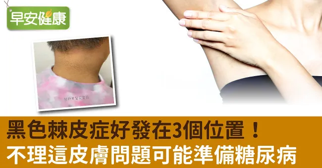 黑色棘皮症好發在3個位置！不理這皮膚問題可能準備糖尿病