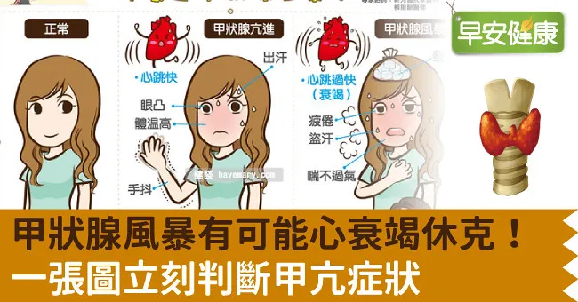 甲狀腺風暴有可能心衰竭休克！一張圖立刻判斷甲亢症狀