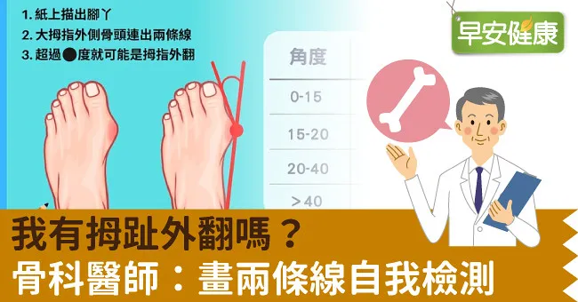 我有拇趾外翻嗎？骨科醫師：畫兩條線自我檢測