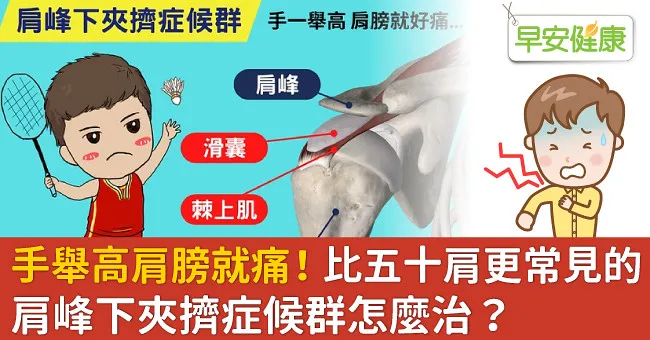 手舉高肩膀就痛！比五十肩更常見的肩峰下夾擠症候群怎麼治？