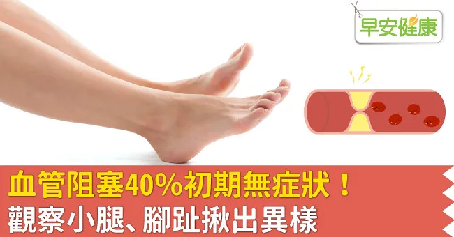 血管阻塞40％初期無症狀！觀察小腿、腳趾揪出異樣