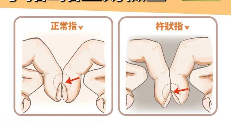 肺癌發生率比「癌王」高出許多！醫師教肺癌小測試：手指一靠看出異樣