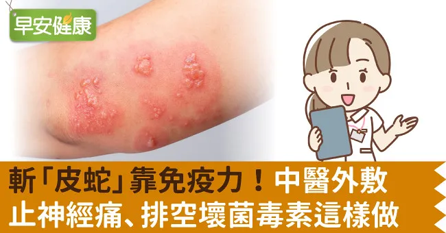 斬「皮蛇」靠免疫力！中醫外敷止神經痛、排空壞菌毒素這樣做