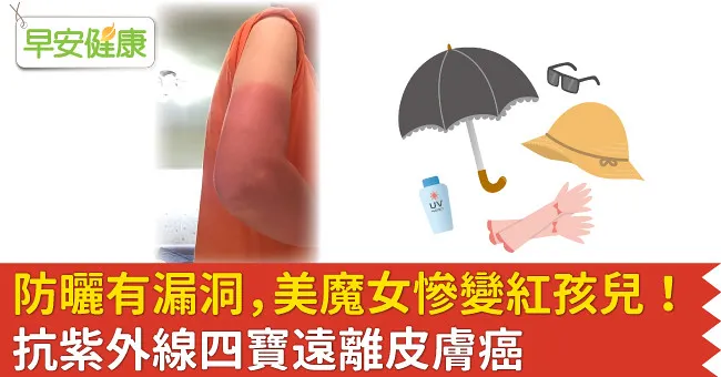 防曬有漏洞，美魔女慘變紅孩兒！抗紫外線四寶遠離皮膚癌