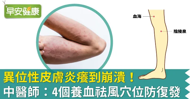異位性皮膚炎癢到崩潰！中醫師：4個養血祛風穴位防復發