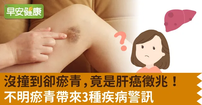 沒撞到卻瘀青，竟是肝癌徵兆！不明瘀青帶來3種疾病警訊