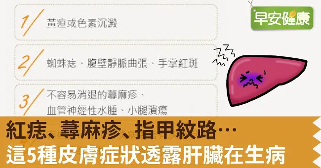 紅痣、蕁麻疹、指甲紋路…這5種皮膚症狀透露肝臟在生病
