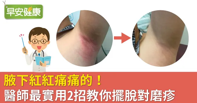 腋下紅紅痛痛的！醫師最實用2招教你擺脫對磨疹