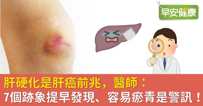 肝硬化是肝癌前兆，醫師：7個跡象提早發現、容易瘀青是警訊！