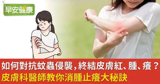 如何對抗蚊蟲侵襲，終結皮膚紅、腫、癢？皮膚科醫師教你消腫止癢大秘訣
