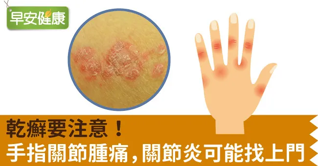 乾癬要注意！手指關節腫痛，關節炎可能找上門