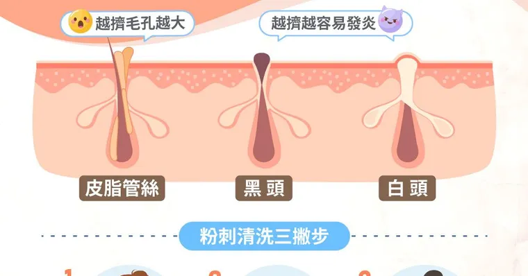 夏天總狂冒粉刺？皮膚科醫師、美容專家教3招：從根本消除粉刺不用擠！