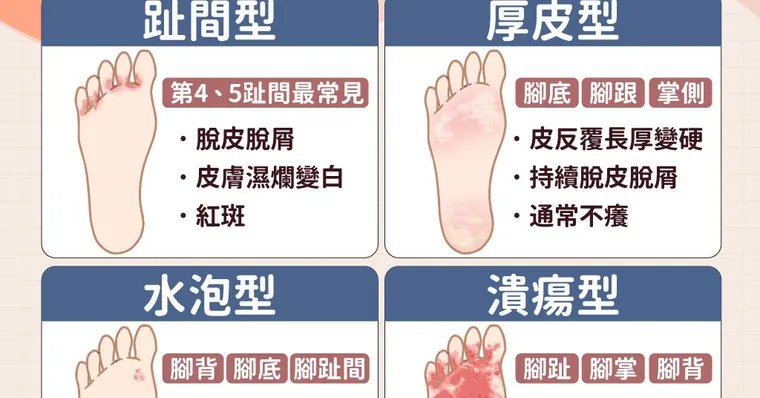 香港腳怎麼治？症狀、藥膏選擇與何時就醫一次看