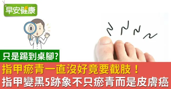 指甲瘀青一直沒好竟要截肢！指甲變黑5跡象不只瘀青而是皮膚癌