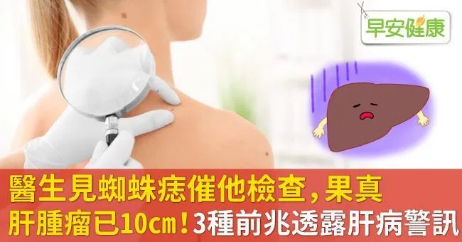 醫生見蜘蛛痣催他檢查，果真肝腫瘤已10cm！3種前兆透露肝病警訊