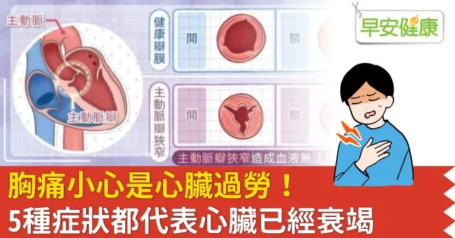 胸痛小心是心臟過勞！5種症狀都代表心臟已經衰竭