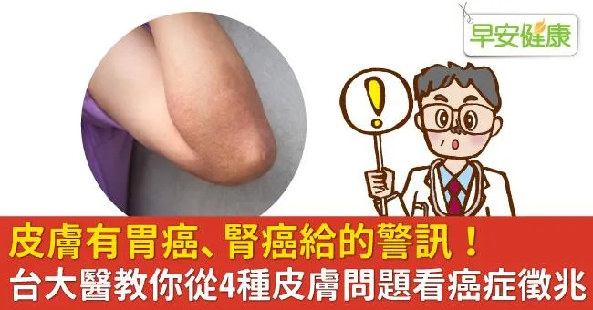 皮膚有胃癌、腎癌給的警訊！台大醫教你從4種皮膚問題看癌症徵兆